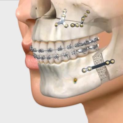 Сплинт терапия в стоматологии снижение высоты прикуса